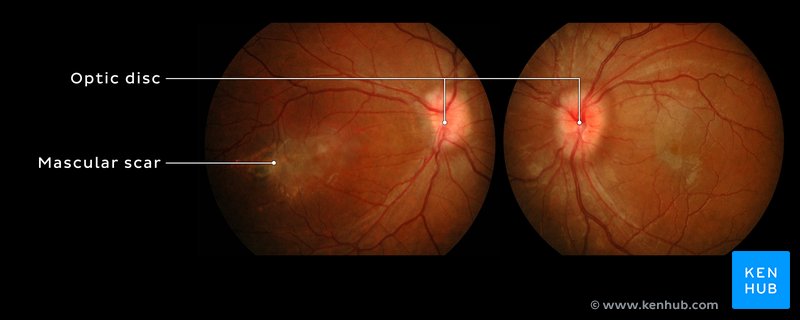 Swollen optic disc and macular scar