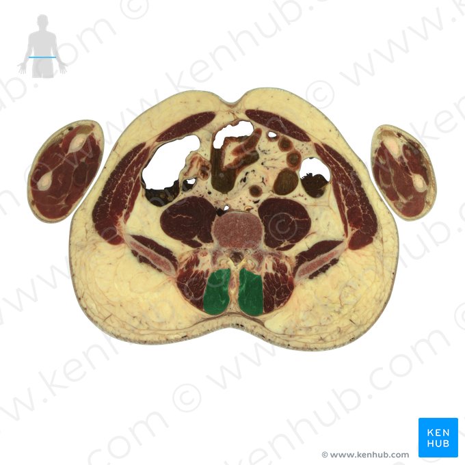 Músculo multífido (Musculus multifidus); Imagem: National Library of Medicine