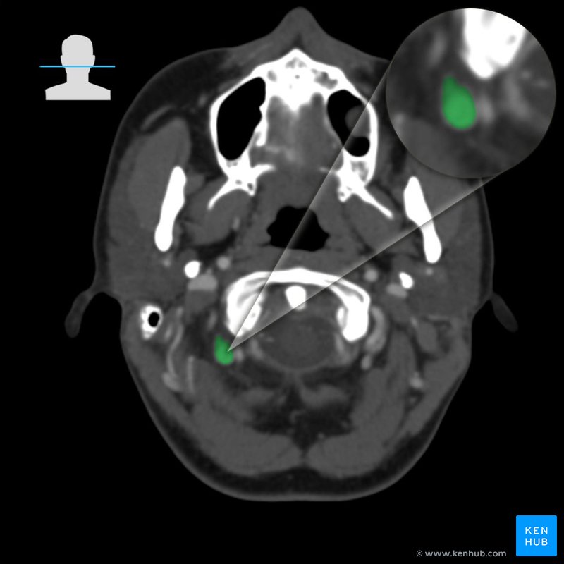 Condylar emissary vein