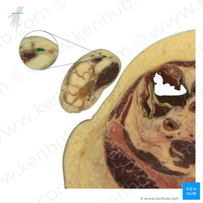 Tendon of extensor pollicis brevis muscle (Tendo musculi extensoris pollicis brevis); Image: National Library of Medicine