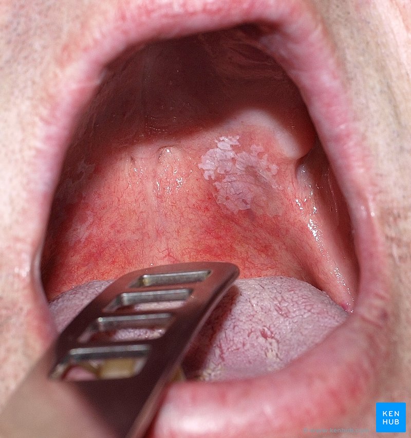 Fig 1. Leucoplasia na mucosa oral