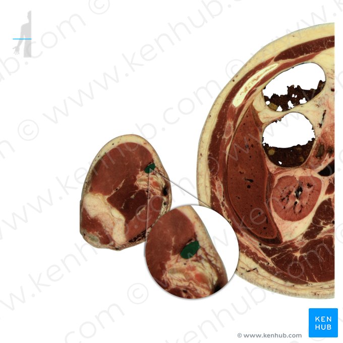 Veia cefálica (Vena cephalica); Imagem: National Library of Medicine