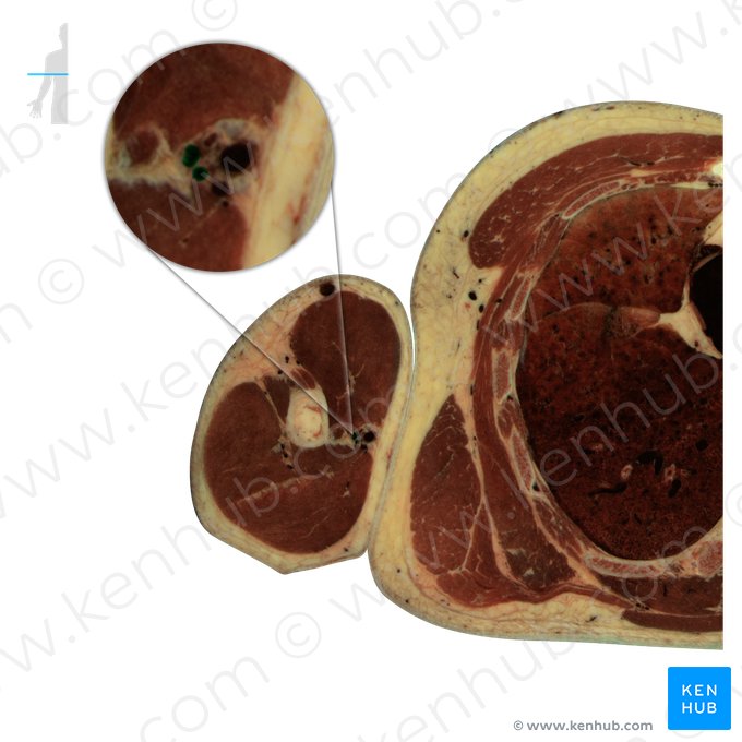 Brachial veins (Venae brachiales); Image: National Library of Medicine