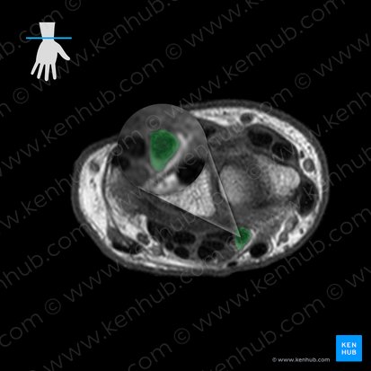 Tendão do músculo flexor longo do polegar (Tendo musculi flexoris pollicis longi); Imagem: 