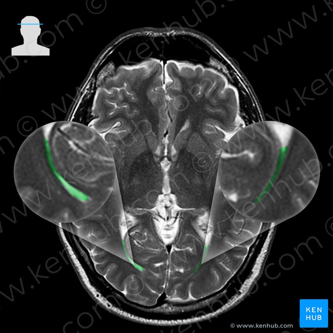 Asta occipital del ventrículo lateral (Cornu occipitale ventriculi lateralis); Imagen: 