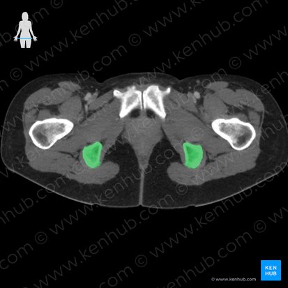 Tuberosidad del isquion (Tuber ischiadicum); Imagen: 