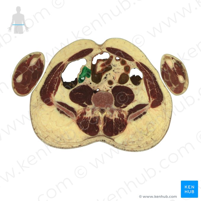 Terminal part of ileum (Pars terminalis ilei); Image: National Library of Medicine