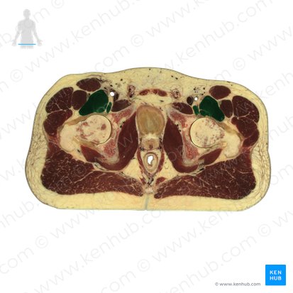 Musculus iliopsoas (Darmbein-Lenden-Muskel); Bild: National Library of Medicine