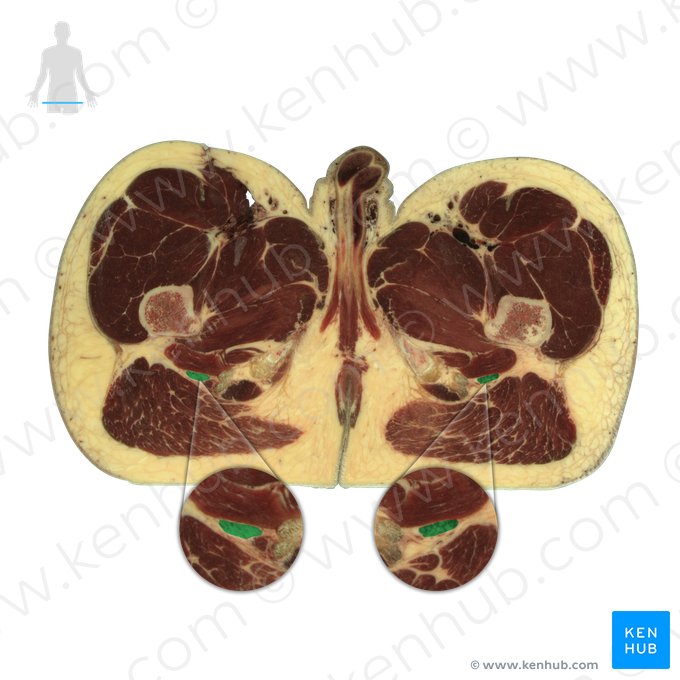 Sciatic nerve (Nervus ischiadicus); Image: National Library of Medicine