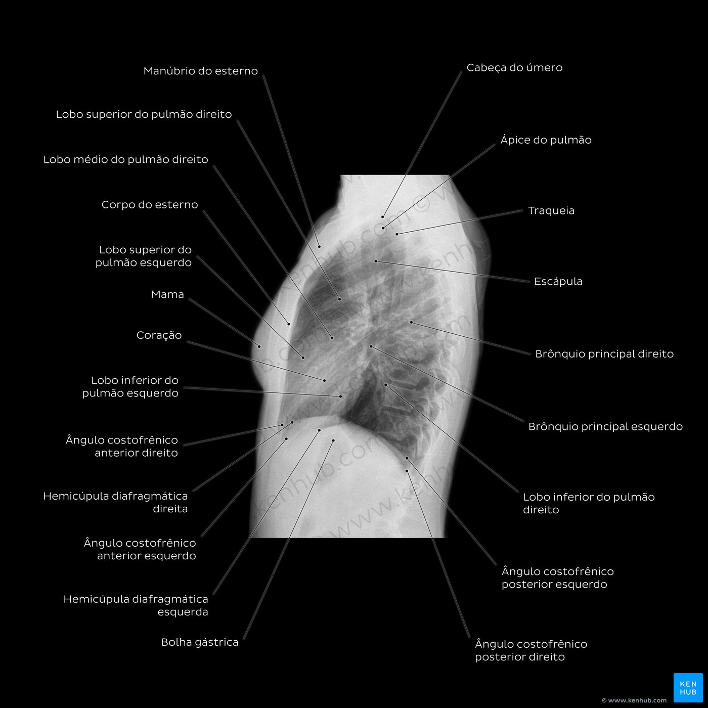 Esquema de Raio X de tórax - projeção lateral