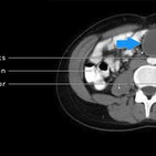 Clinical case: Urachal cyst