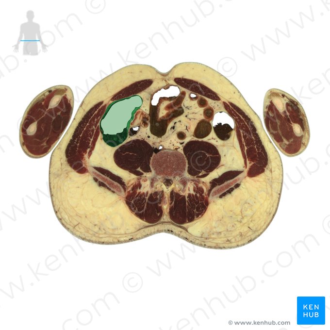 Caecum (Blinddarm); Bild: National Library of Medicine