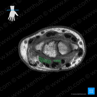 Tendón del músculo flexor profundo de los dedos (Tendines musculi flexoris digitorum profundus); Imagen: 