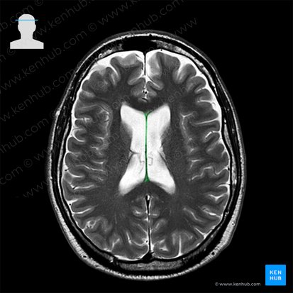 Septum pellucidum; Image: 