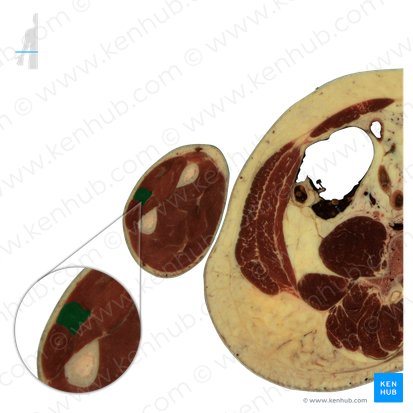 Extensor digiti minimi muscle (Musculus extensor digiti minimi); Image: National Library of Medicine