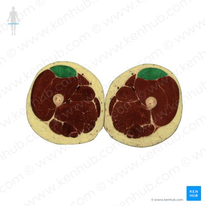 Musculus rectus femoris (Gerader Oberschenkelmuskel); Bild: National Library of Medicine