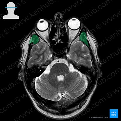 Musculus temporalis (Schläfenmuskel); Bild: 