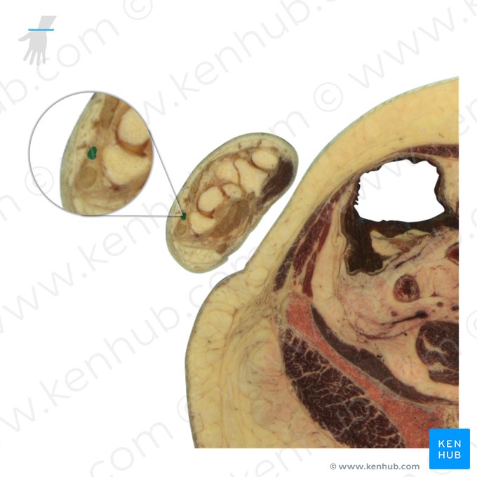 Tendão do músculo extensor do dedo mínimo (Tendo musculi extensoris digiti minimi); Imagem: National Library of Medicine