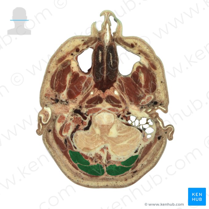 Semispinalis capitis muscle (Musculus semispinalis capitis); Image: National Library of Medicine