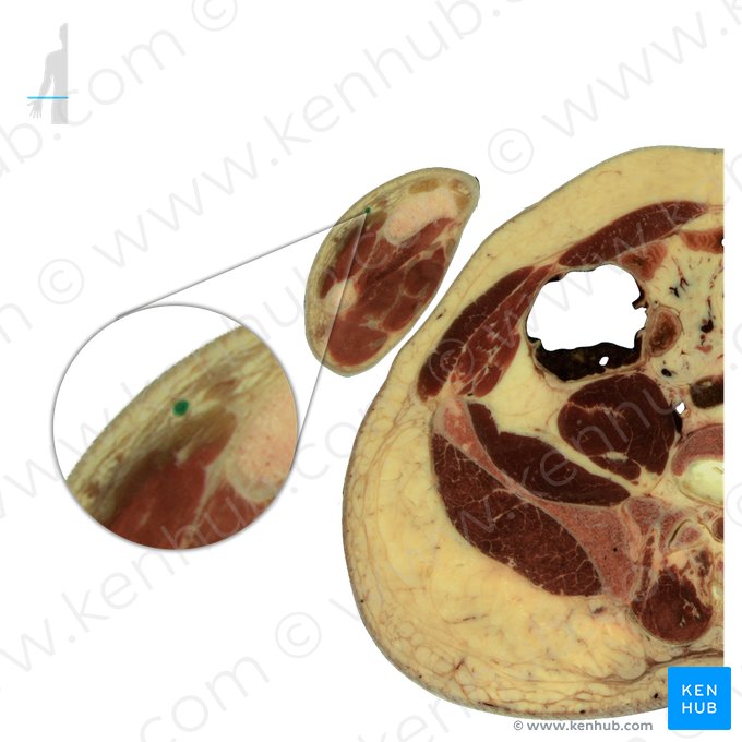Cephalic vein (Vena cephalica); Image: National Library of Medicine