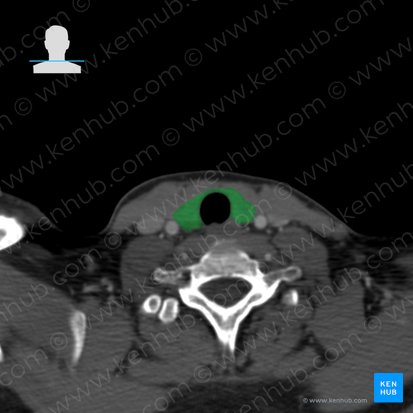 Glândula tireoide (Glandula thyroidea); Imagem: 