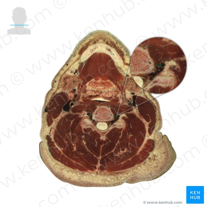 Vertebral artery (Arteria vertebralis); Image: National Library of Medicine