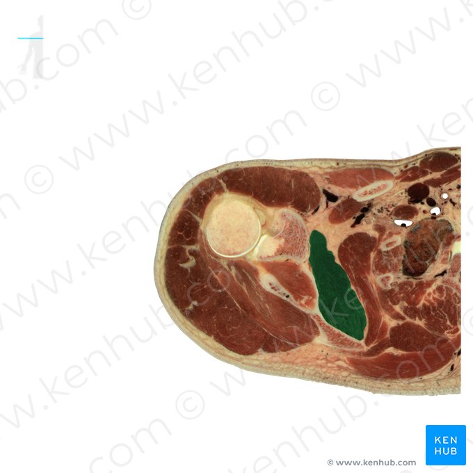 Subscapularis muscle (Musculus subscapularis); Image: National Library of Medicine