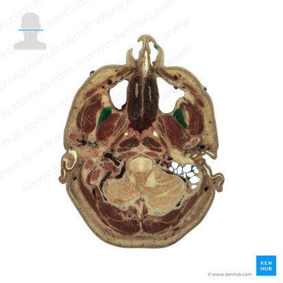 Temporalis muscle (Musculus temporalis); Image: National Library of Medicine