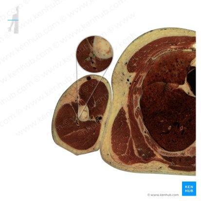 Nervus radialis (Speichennerv); Bild: National Library of Medicine