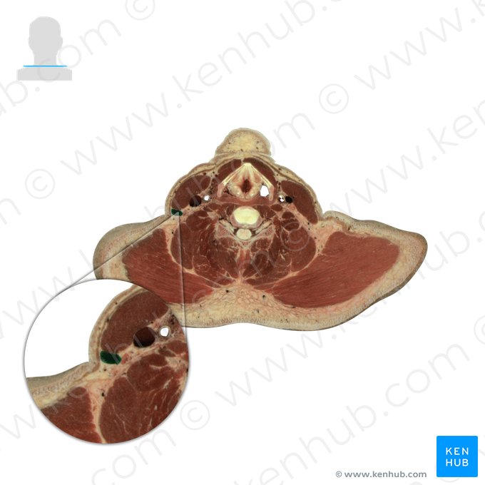 External jugular vein (Vena jugularis externa); Image: National Library of Medicine
