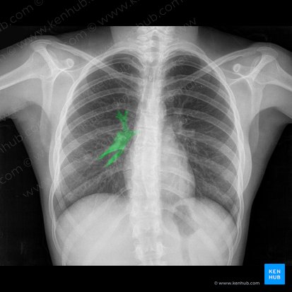 Ramos da artéria pulmonar direita (Rami arteriae pulmonalis dextrae); Imagem: 