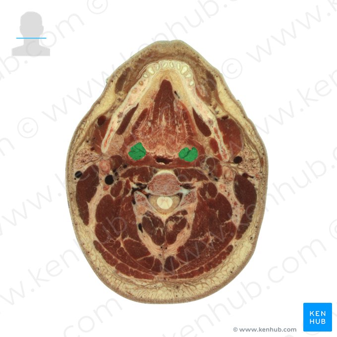 Tonsila palatina (Tonsilla palatina); Imagem: National Library of Medicine