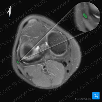 Ligamento colateral fibular de la articulación de la rodilla (Ligamentum collaterale fibulare genus); Imagen: 