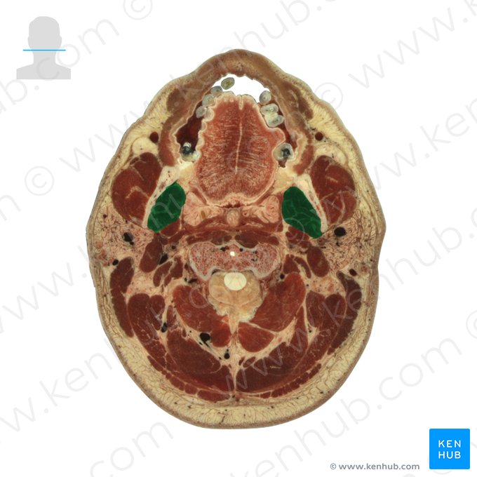 Músculo pterigóideo medial (Musculus pterygoideus medialis); Imagem: National Library of Medicine