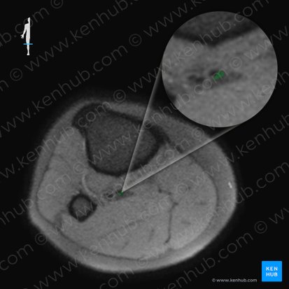 Posterior tibial vein (Vena tibialis posterior); Image: 