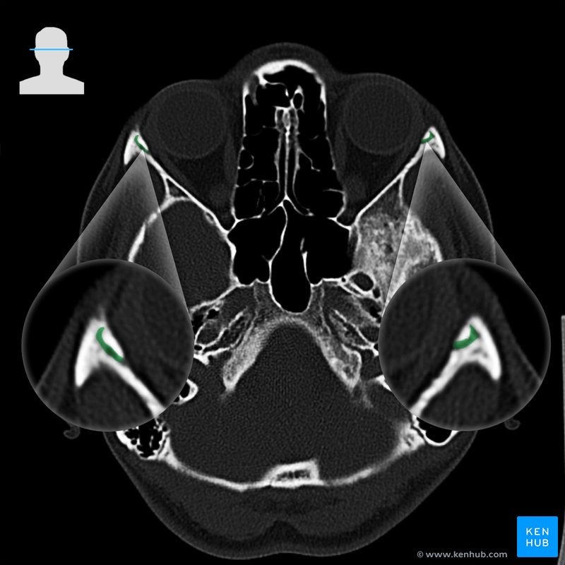 Sutura frontozigomática - corte axial