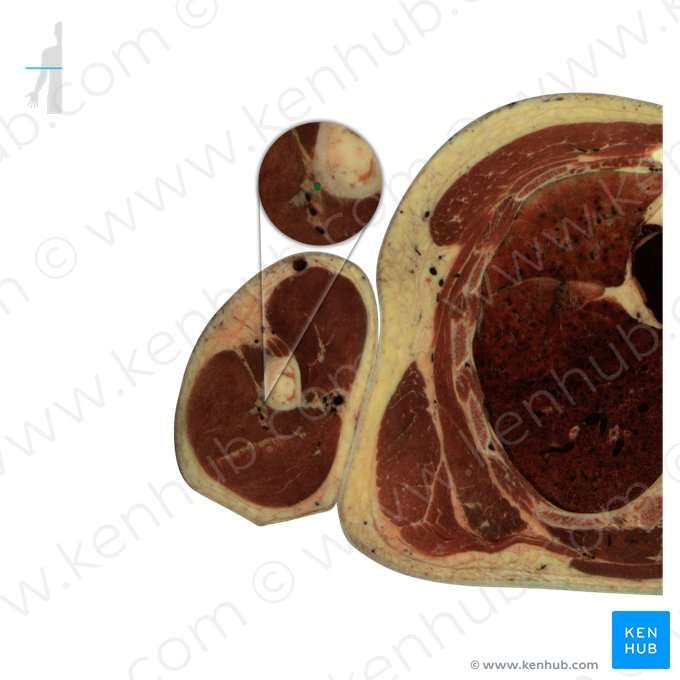 Radial nerve (Nervus radialis); Image: National Library of Medicine