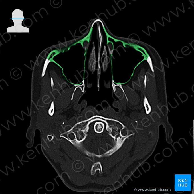 Maxilla (Oberkieferknochen); Bild: 