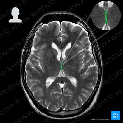 Ventriculus tertius (Dritter Ventrikel); Bild: 