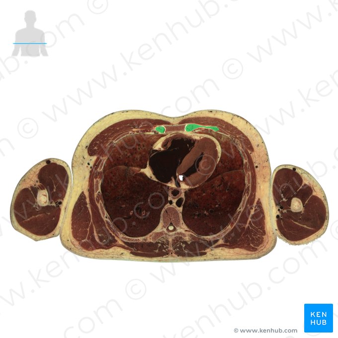 Costal cartilage of 4th rib (Cartilago costalis costae 4); Image: National Library of Medicine