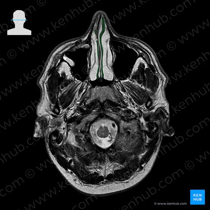 Common nasal meatus (Meatus nasalis communis); Image: 