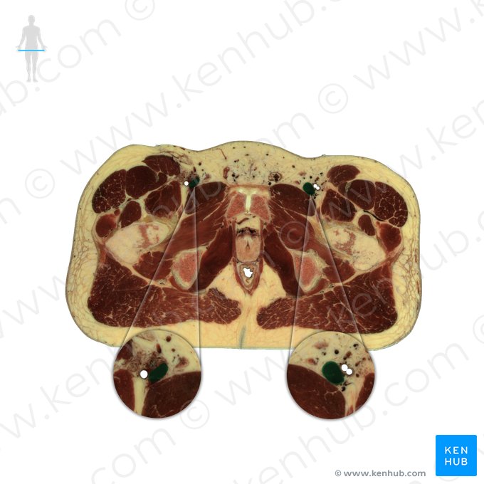 Veia femoral (Vena femoralis); Imagem: National Library of Medicine