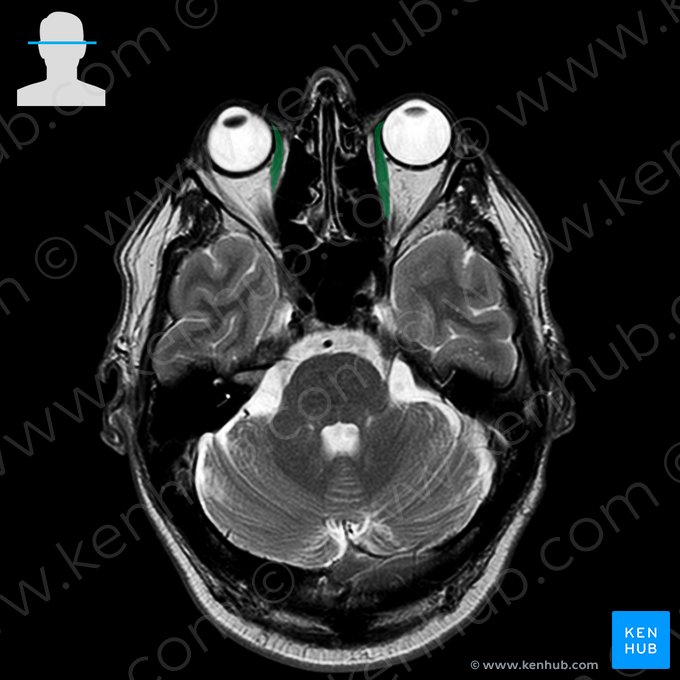 Medial rectus muscle (Musculus rectus medialis); Image: 