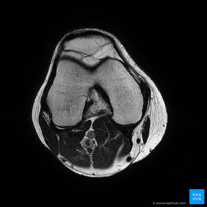 Knee MRI