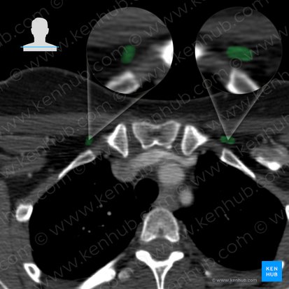 Músculo subclávio (Musculus subclavius); Imagem: 