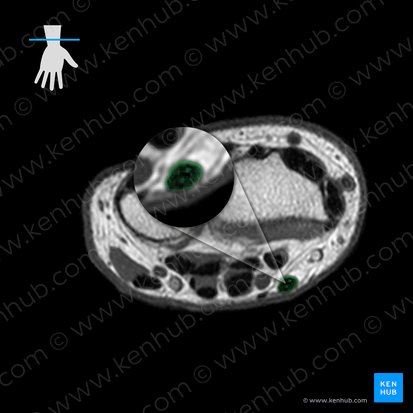 Tendão do músculo flexor radial do carpo (Tendo musculi flexoris carpi radialis); Imagem: 