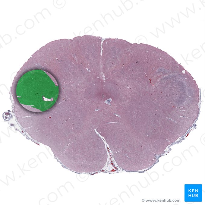 Núcleo espinal del nervio trigémino (Nucleus spinalis nervi trigemini); Imagen: 