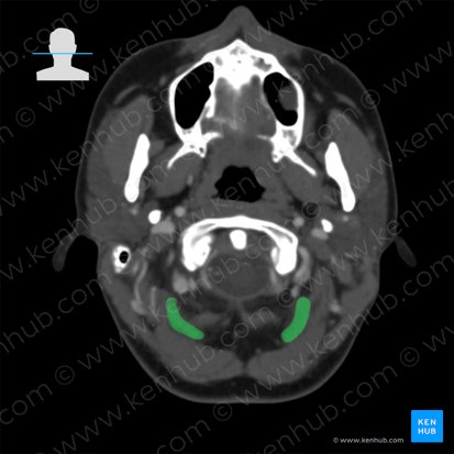 Músculo reto posterior maior da cabeça (Musculus rectus capitis posterior major); Imagem: 