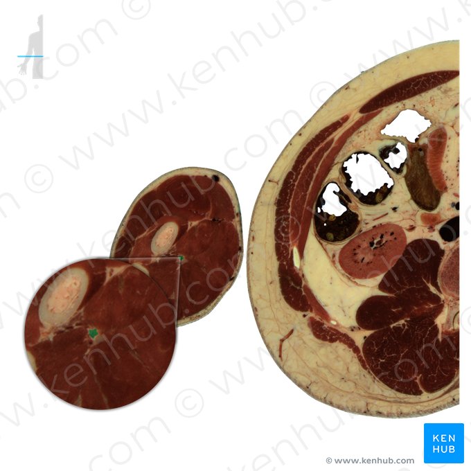 Nervo mediano (Nervus medianus); Imagem: National Library of Medicine