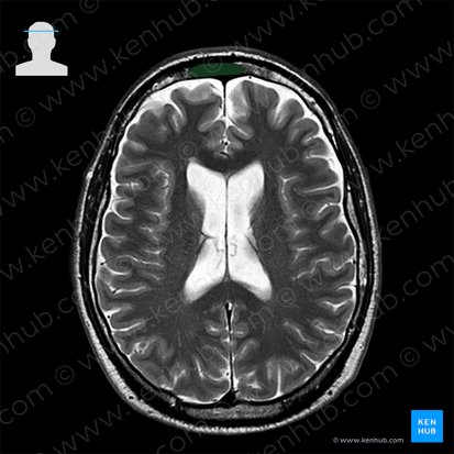 Frontal sinus (Sinus frontalis); Image: 